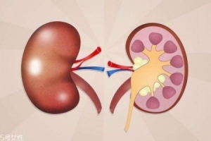肾结石日常注意什么 肾结石饮食禁忌