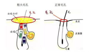 脸上毛孔粗大像鸡皮一样该怎么处理