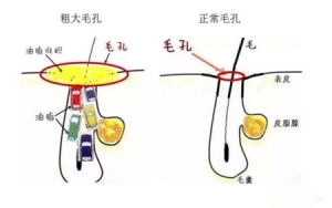 脸上毛孔粗大像鸡皮一样该怎么处理