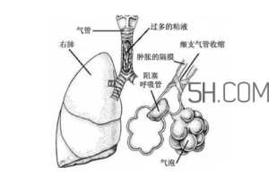 哮喘是怎么引起的?哮喘是什么感觉?