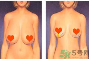 ​女性乳房下垂的真相是什么？女性乳房下垂的分类有哪些？