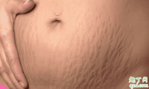 怀孕没妊娠纹产后有了怎么回事 产后健身过度会导致妊娠纹吗2