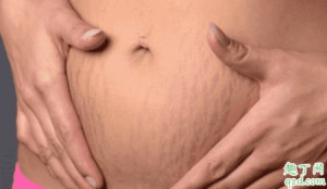 怀孕没妊娠纹产后有了怎么回事 产后健身过度会导致妊娠纹吗4