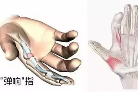 腱鞘炎对身体有什么危害 腱鞘炎对生活有影响吗