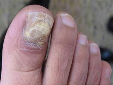 灰指甲是什么原因引起的 灰指甲日常治疗方法