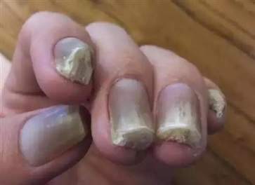 灰指甲是什么原因引起的 灰指甲日常治疗方法