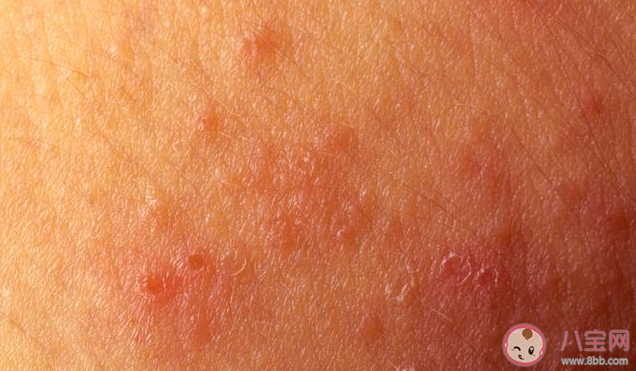 长湿疹是因为湿气重吗 为何夏季湿疹容易加重