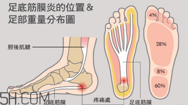 早上下床脚后跟痛真相是这样的_该怎么处理