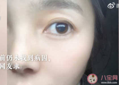 女子左眼瞳孔变大2倍找不到病因 瞳孔变大了会怎么样