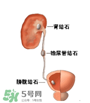 肾结石有什么症状？肾结石真相