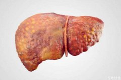 什么是肝癌呢 