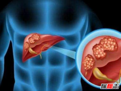 肝癌发病率最高的国家排名 埃及榜上第四 第一酒精过度依赖