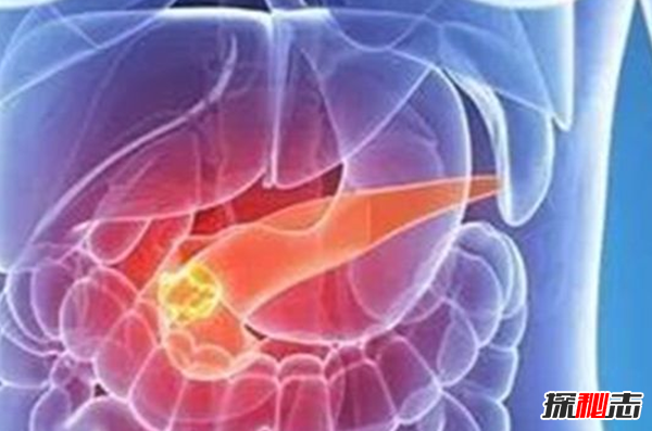 胰腺癌发病率最高的十大国家 无中国 日本榜上第七