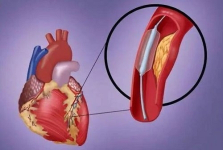心绞痛患者到底应该装心脏支架吗