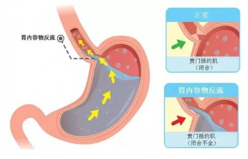 反流性食管炎的病因与预防方法