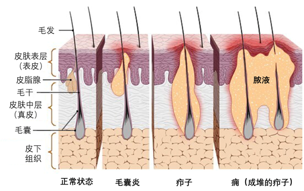 一种“红包”又痛又肿：硬挤还很危险