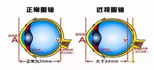 人为什么会近视,近视眼形成的原理是什么